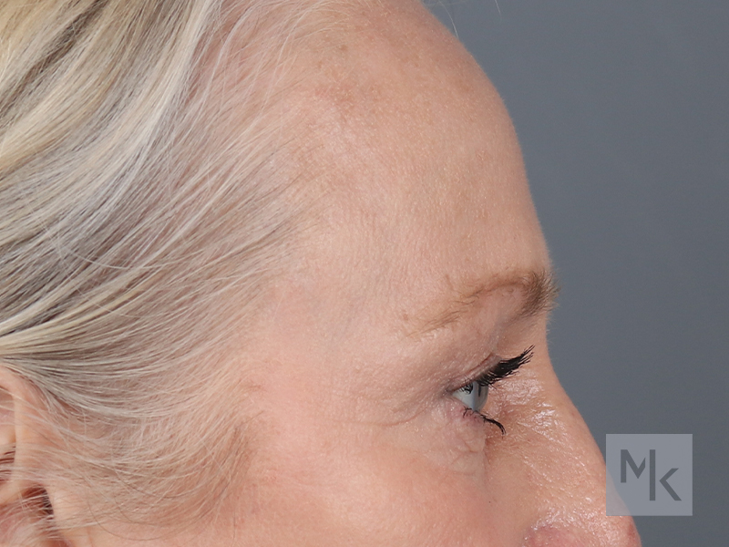 Brow Lift Before and After | Dr. Michael Kim