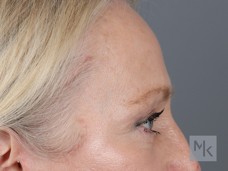 Brow Lift Before and After | Dr. Michael Kim