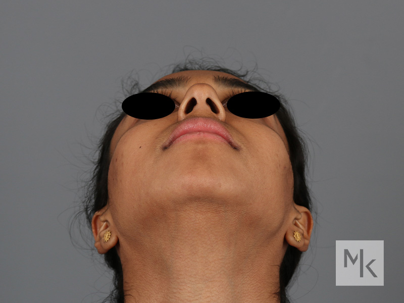 Chin Implant Before and After | Dr. Michael Kim