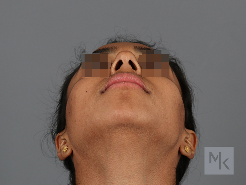 Chin Implant Before and After | Dr. Michael Kim