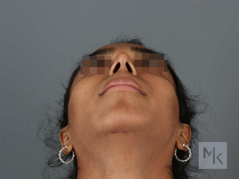 Chin Implant Before and After | Dr. Michael Kim