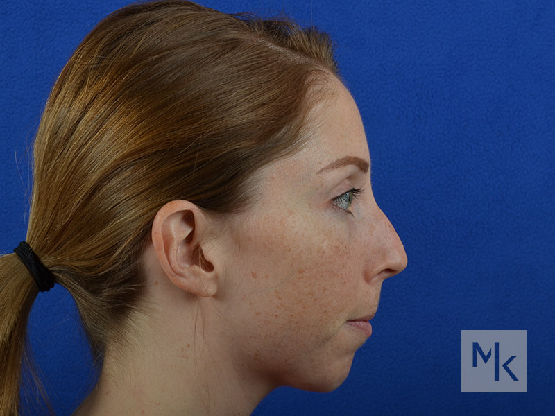 Chin Implant Before and After | Dr. Michael Kim