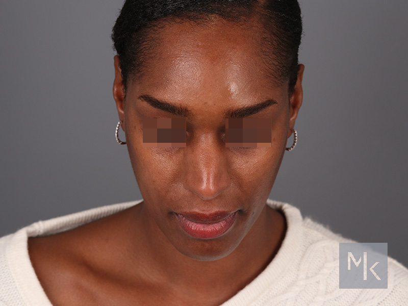 Ethnic Rhinoplasty Before and After | Dr. Michael Kim