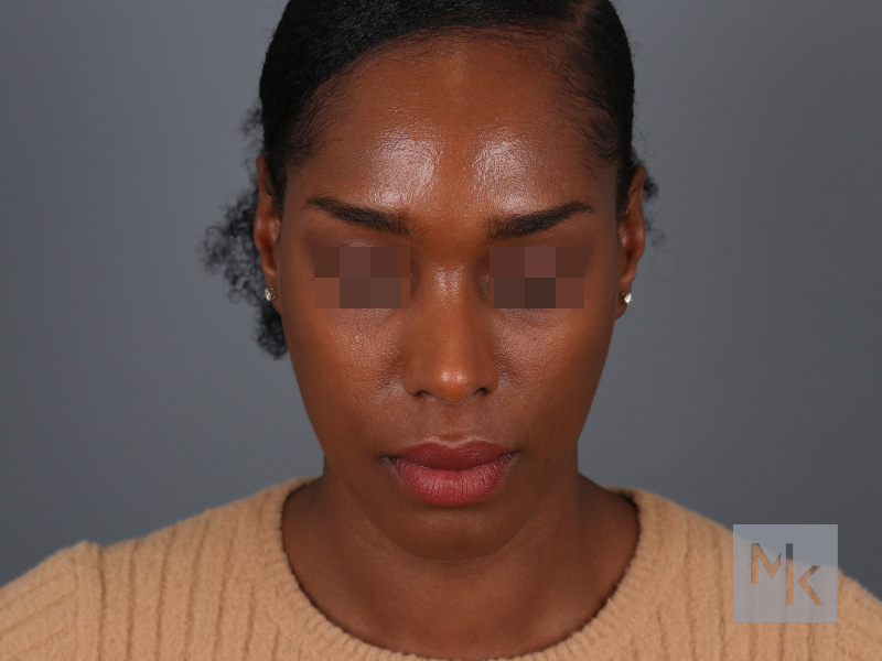 Ethnic Rhinoplasty Before and After | Dr. Michael Kim