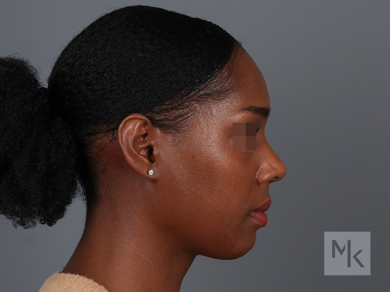 Ethnic Rhinoplasty Before and After | Dr. Michael Kim