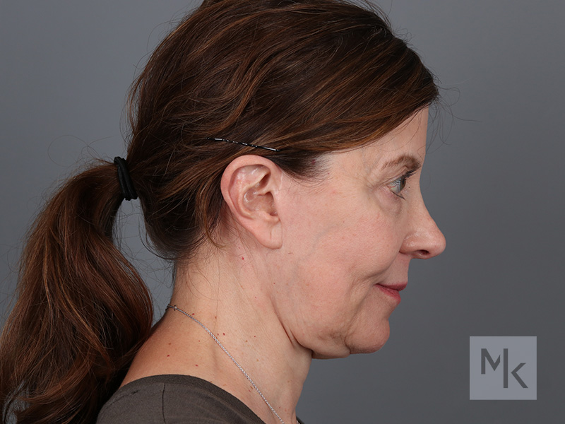 Facelift Before and After | Dr. Michael Kim