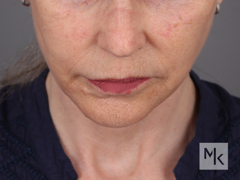 Facelift Before and After | Dr. Michael Kim