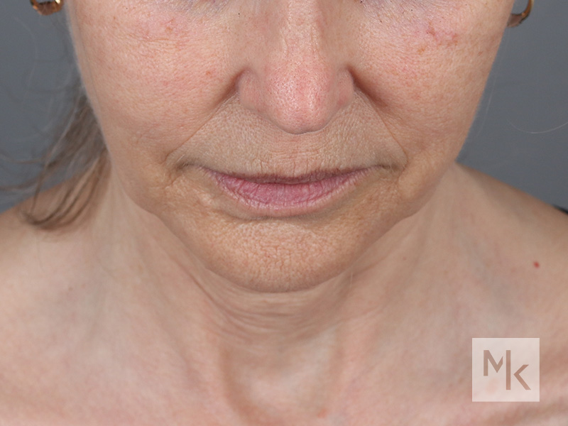 Facelift Before and After | Dr. Michael Kim