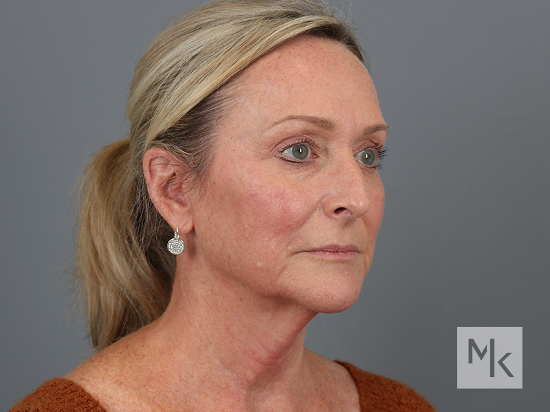 Facelift Before and After | Dr. Michael Kim