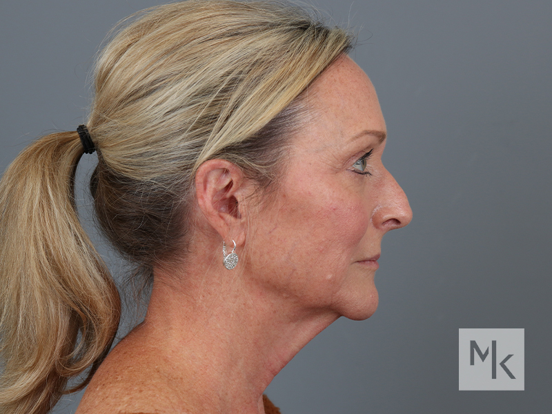 Facelift Before and After | Dr. Michael Kim