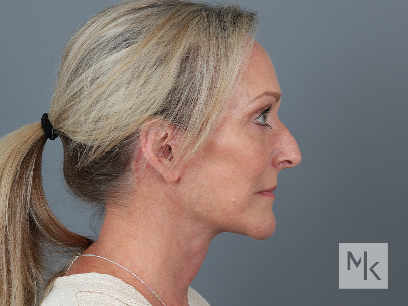 Facelift Before and After | Dr. Michael Kim