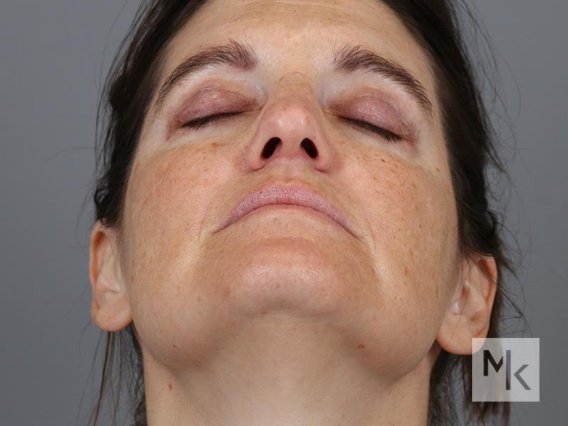 Facelift Before and After | Dr. Michael Kim