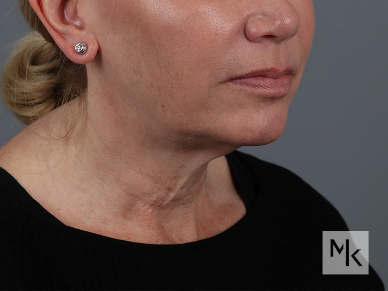 Facelift Before and After | Dr. Michael Kim