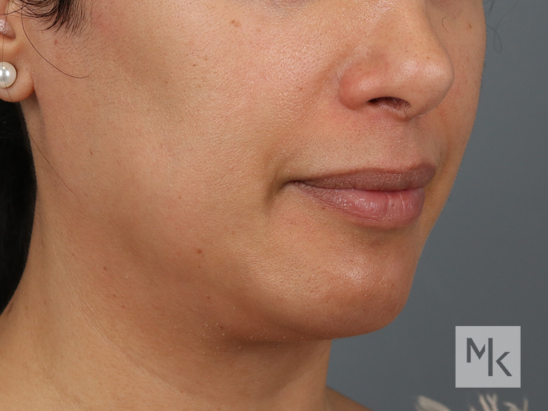 Facelift Before and After | Dr. Michael Kim