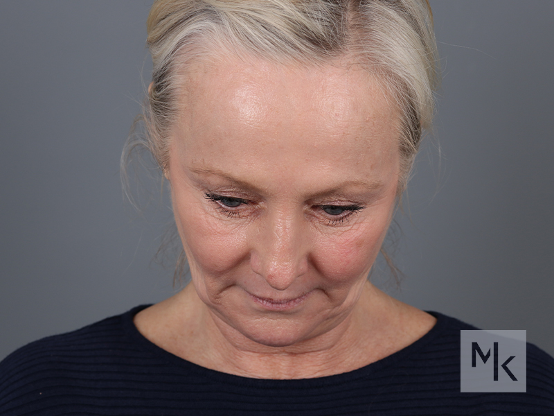 Facelift Before and After | Dr. Michael Kim