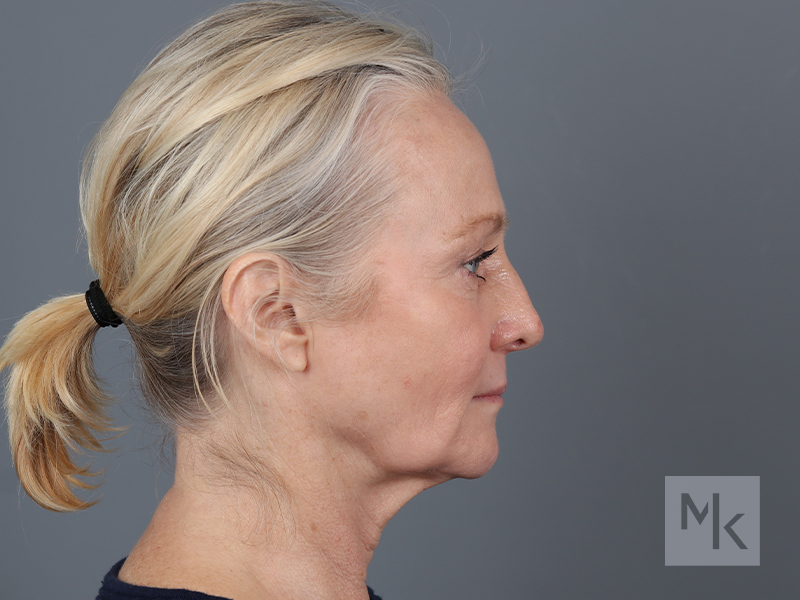 Facelift Before and After | Dr. Michael Kim