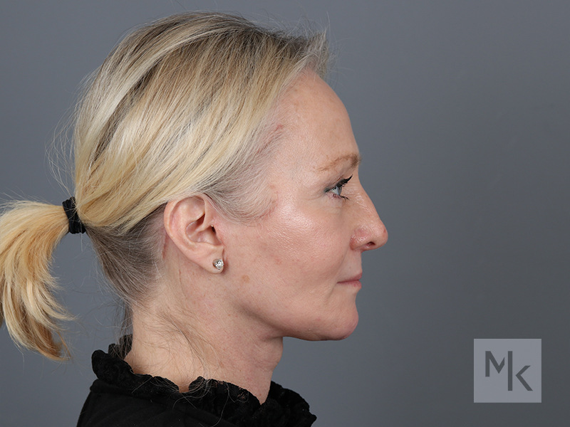 Facelift Before and After | Dr. Michael Kim