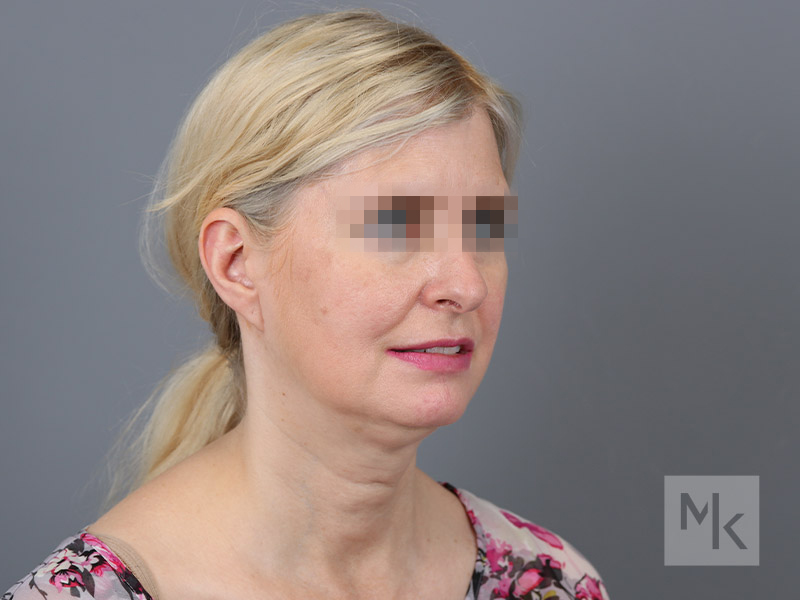 Facelift Before and After 22 | Dr. Michael Kim