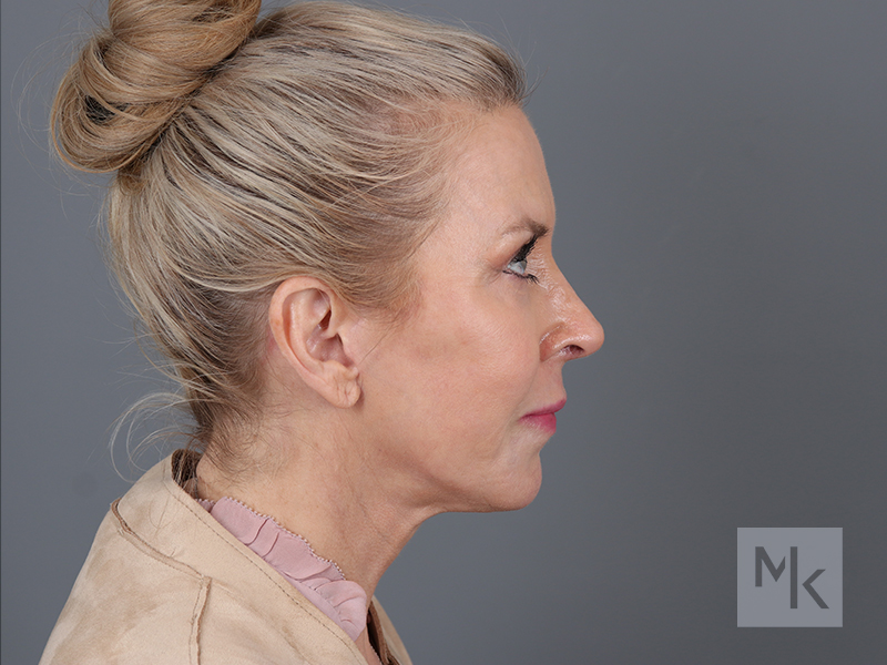 Facelift Before and After | Dr. Michael Kim