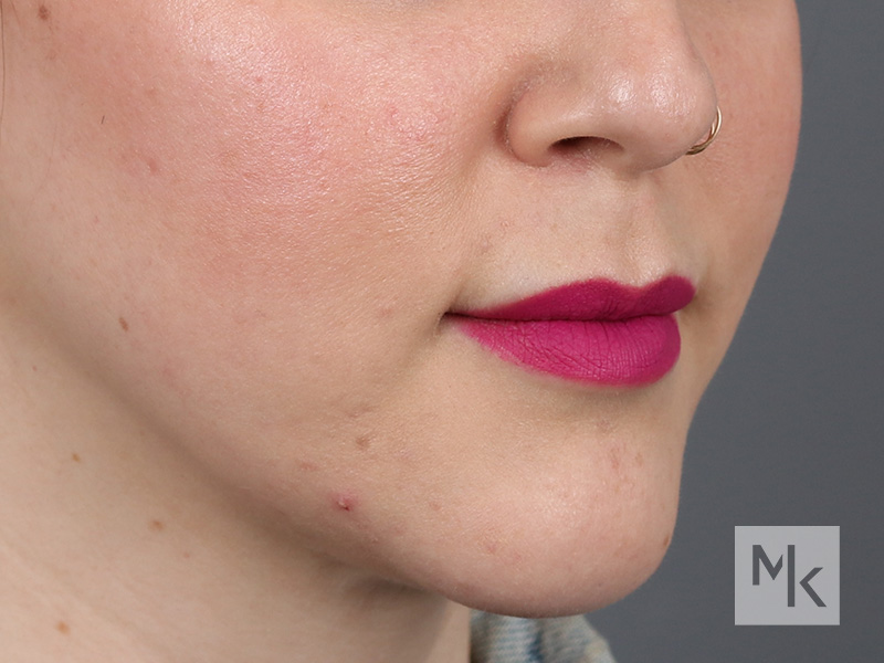 Lip Lift Before and After | Dr. Michael Kim