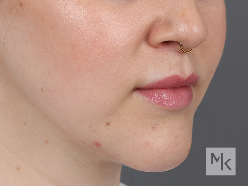 Lip Lift Before and After | Dr. Michael Kim