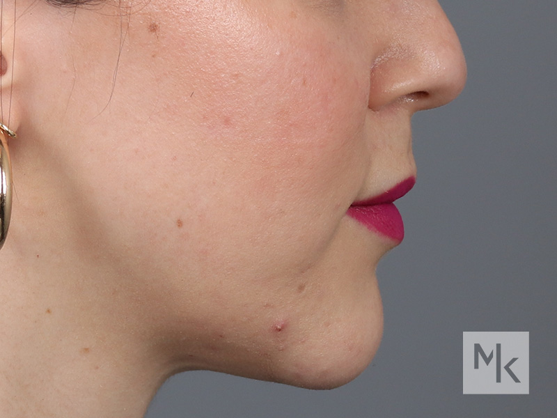 Lip Lift Before and After | Dr. Michael Kim