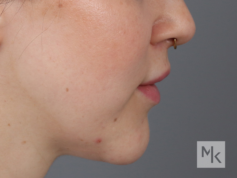 Lip Lift Before and After | Dr. Michael Kim