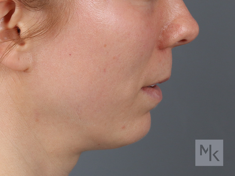 Lip Lift Before and After | Dr. Michael Kim