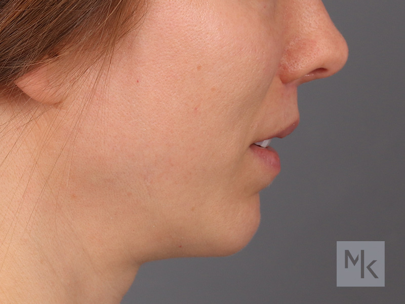 Lip Lift Before and After | Dr. Michael Kim