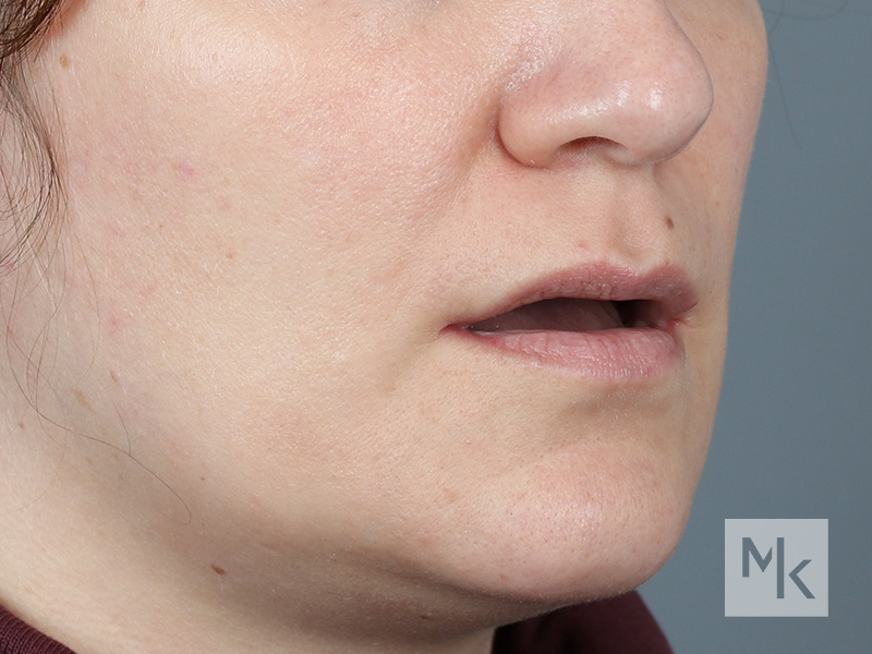 Lip Lift Before and After | Dr. Michael Kim