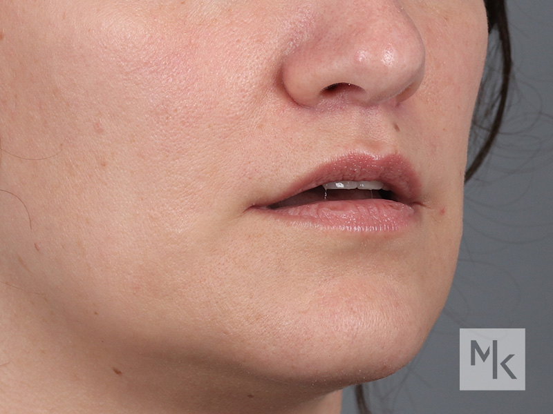 Lip Lift Before and After | Dr. Michael Kim