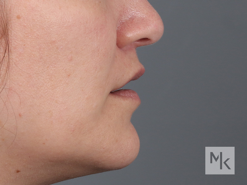 Lip Lift Before and After | Dr. Michael Kim