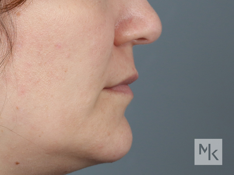 Lip Lift Before and After | Dr. Michael Kim