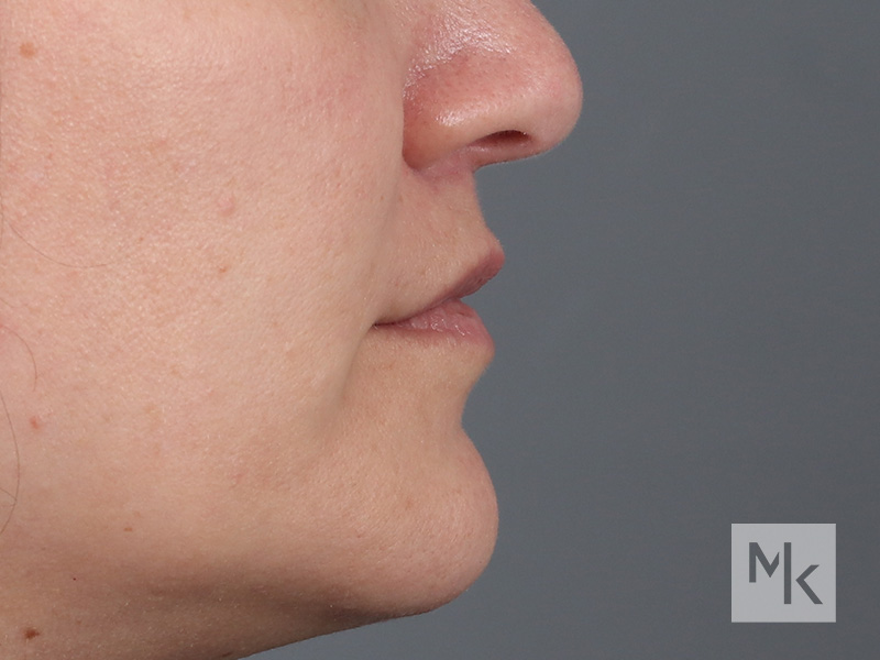 Lip Lift Before and After | Dr. Michael Kim