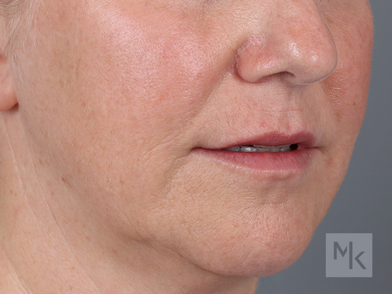 Lip Lift Before and After | Dr. Michael Kim