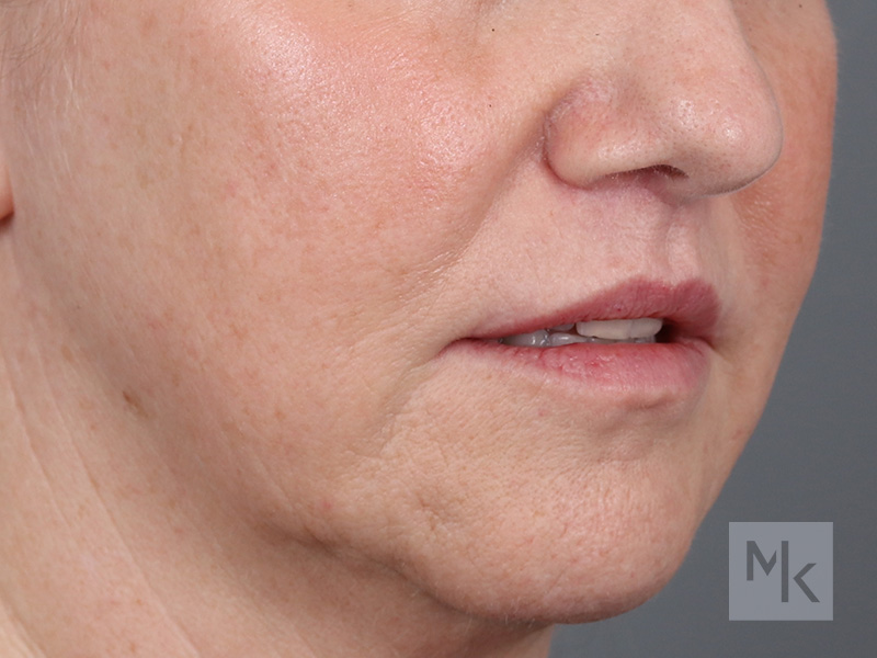 Lip Lift Before and After | Dr. Michael Kim