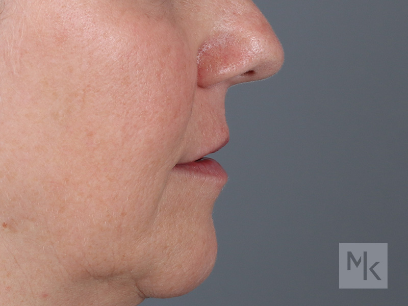 Lip Lift Before and After | Dr. Michael Kim