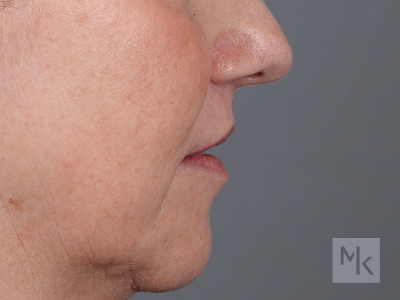 Lip Lift Before and After | Dr. Michael Kim