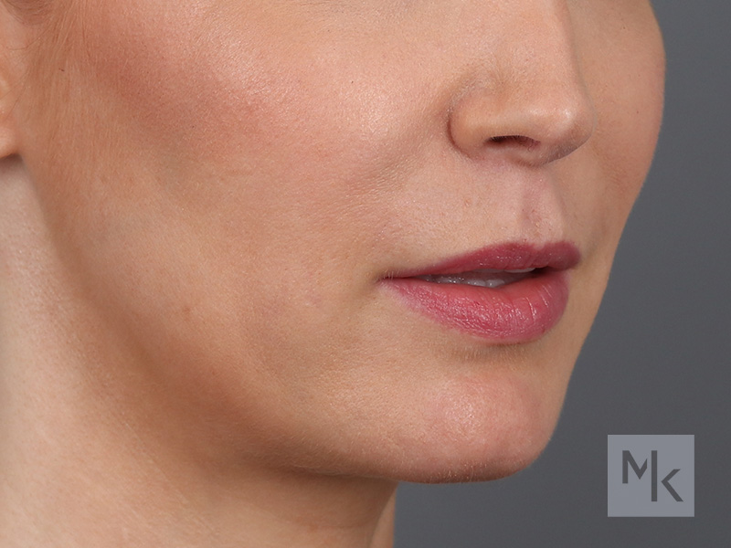 Lip Lift Before and After | Dr. Michael Kim