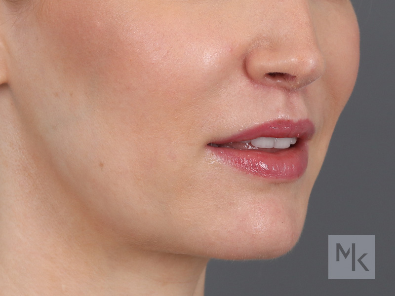 Lip Lift Before and After | Dr. Michael Kim