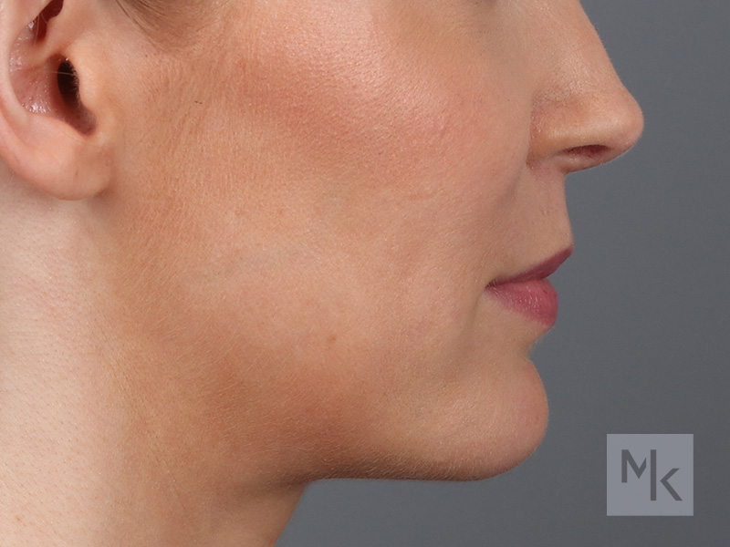 Lip Lift Before and After | Dr. Michael Kim