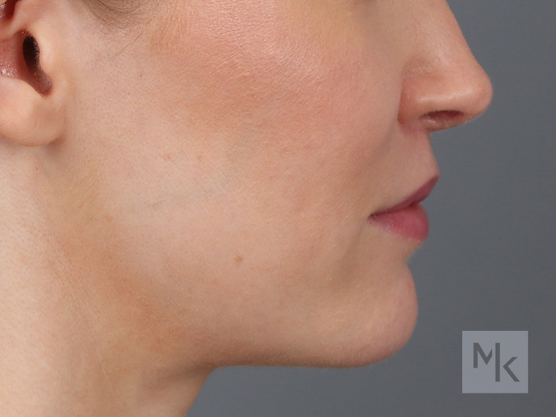 Lip Lift Before and After | Dr. Michael Kim