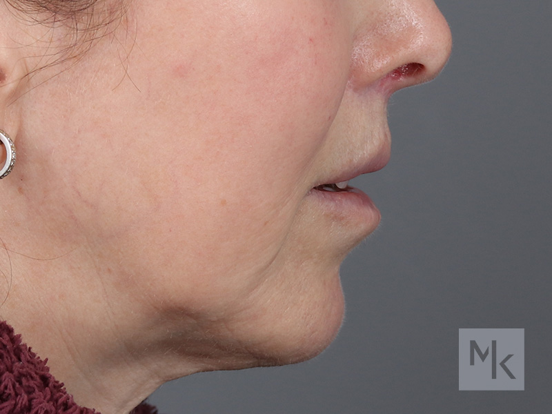 Lip Lift Before and After | Dr. Michael Kim