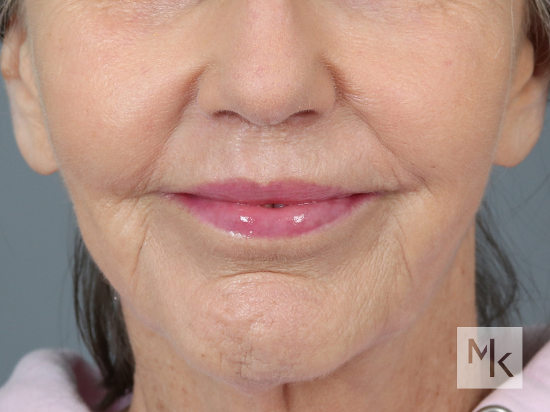 Lip Lift Before and After | Dr. Michael Kim