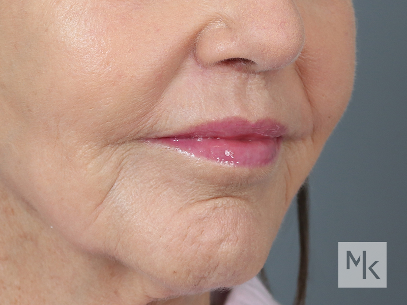 Lip Lift Before and After | Dr. Michael Kim