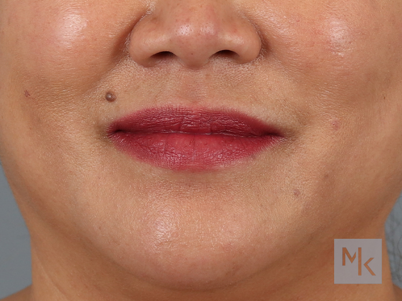 Lip Lift Before and After | Dr. Michael Kim