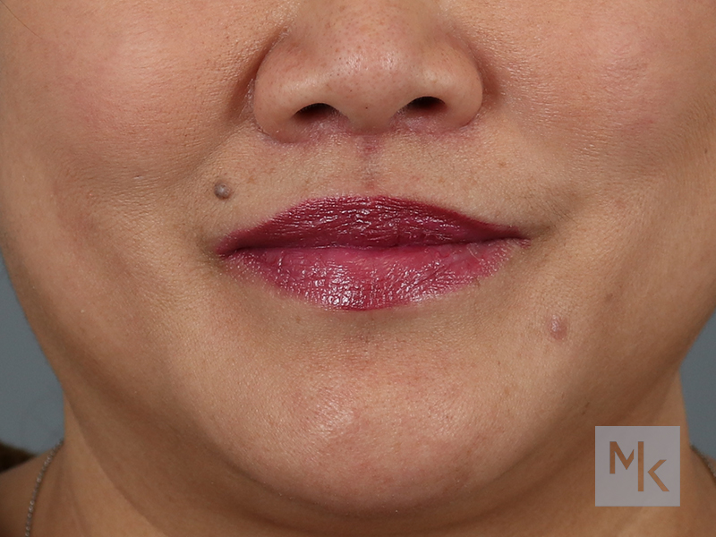 Lip Lift Before and After | Dr. Michael Kim