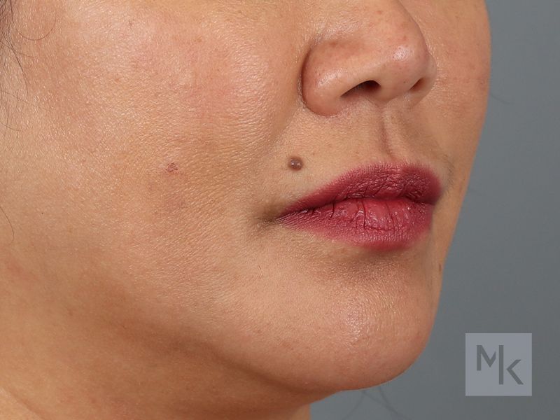 Lip Lift Before and After | Dr. Michael Kim