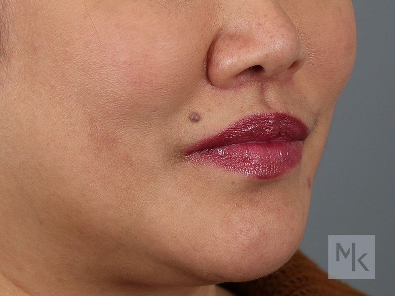 Lip Lift Before and After | Dr. Michael Kim