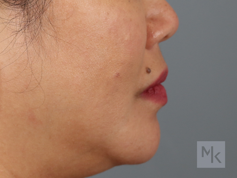 Lip Lift Before and After | Dr. Michael Kim